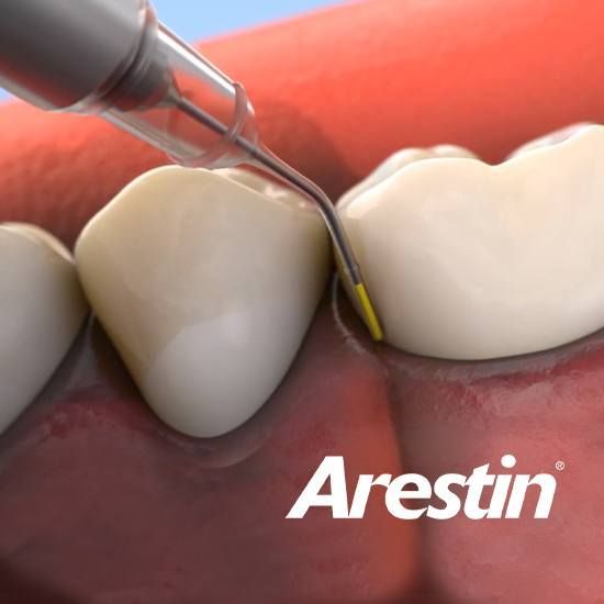 Illustration of Arestin treatment.