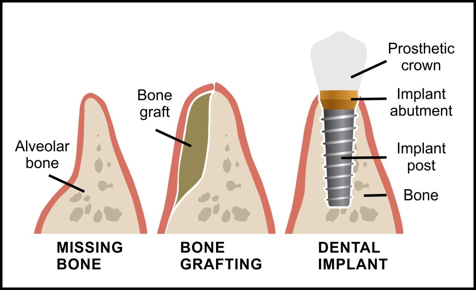 Bone graft illustration
