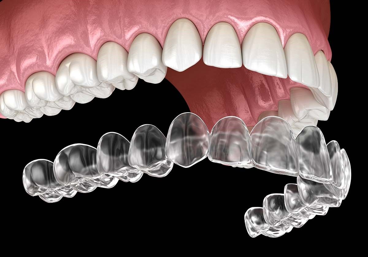 a close up of a model of teeth with braces