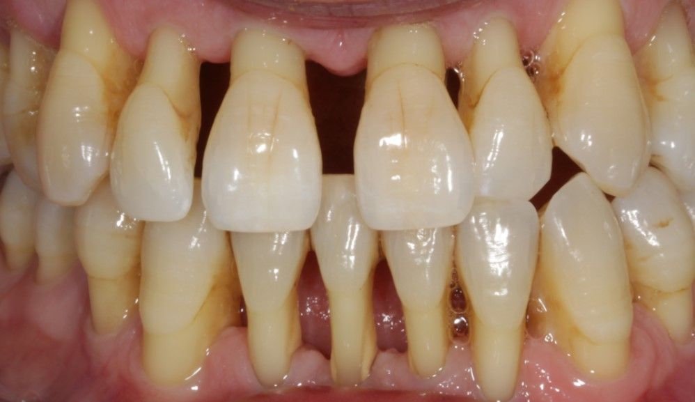 advanced gum disease