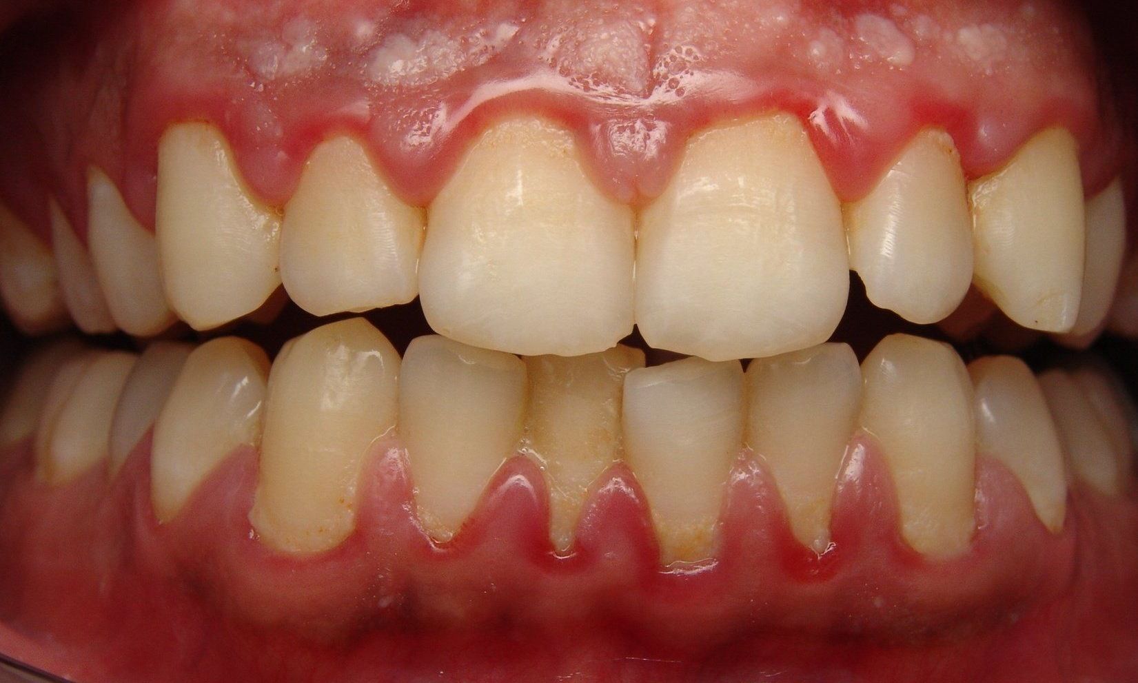 a close up of a person 's teeth with red gums .
