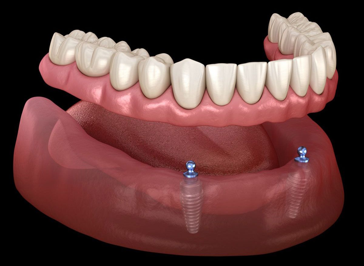 Implants with lower denture