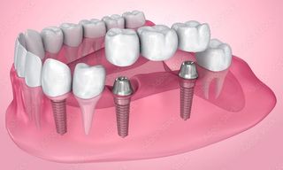 a 3d model of a dental bridge with dental implants .