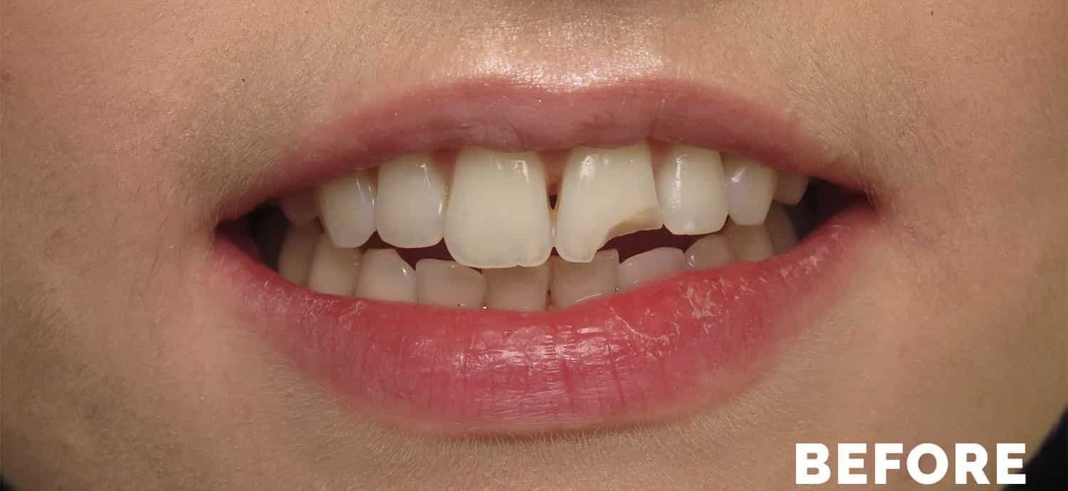 Single tooth composite bonding - before
