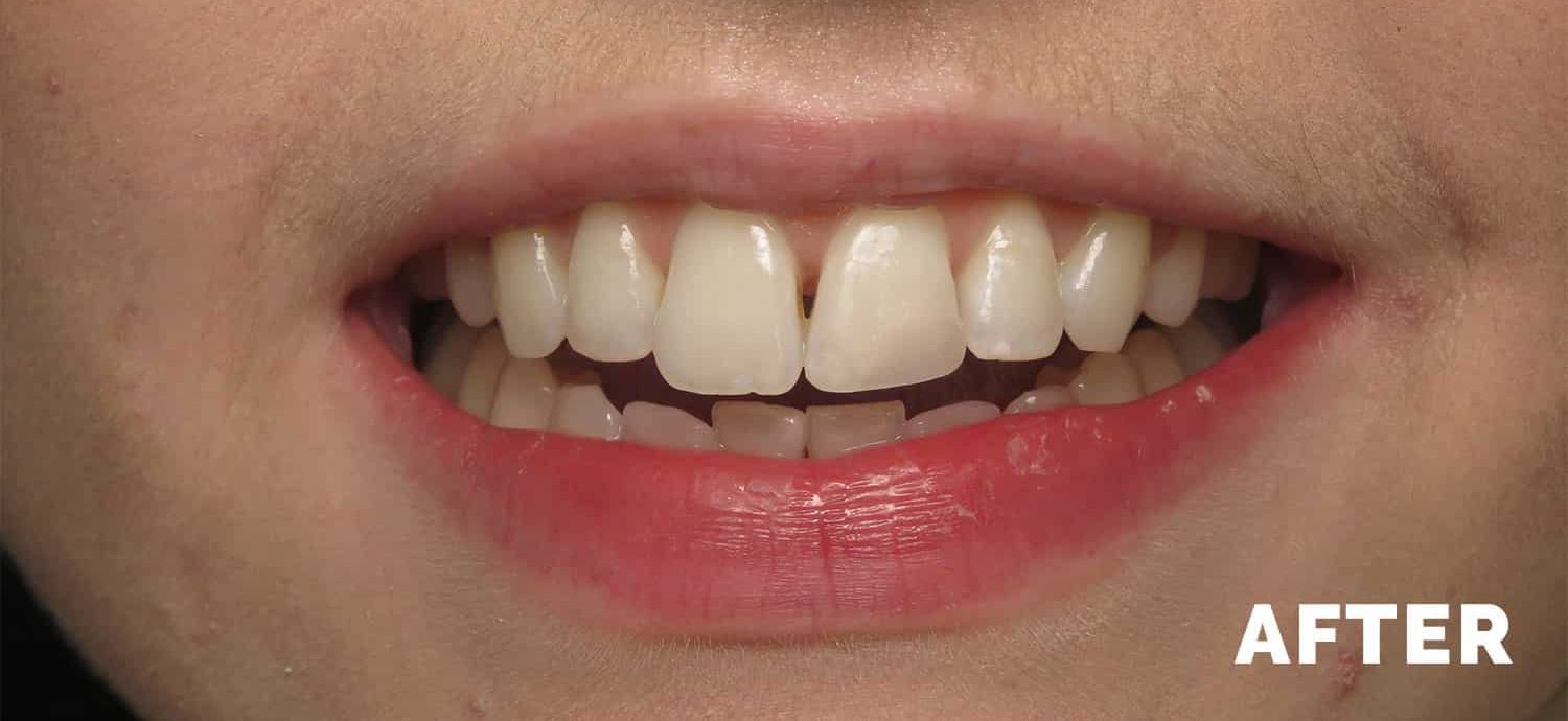 Single tooth composite bonding - after