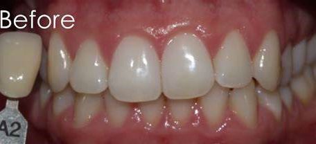 Zoom teeth whitening - before