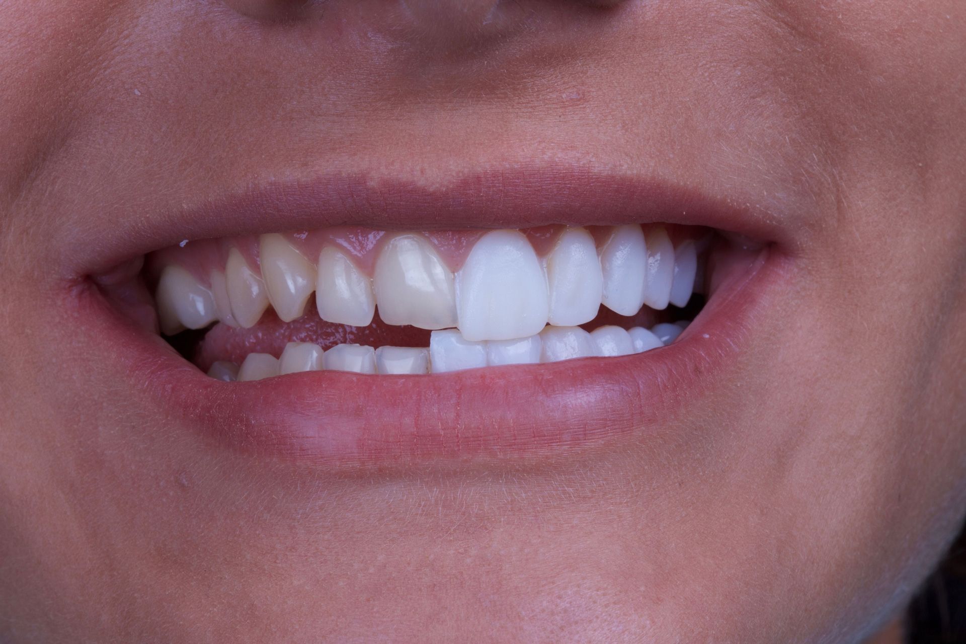 Close up of dental patient with veneers