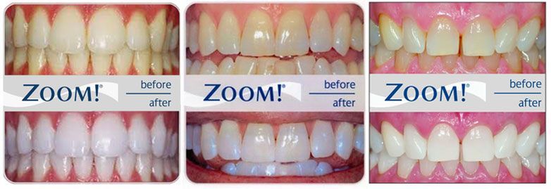 Zoom teeth whitening treatments - before and after