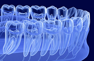 Root canals
