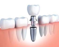 implant dentist decatur il