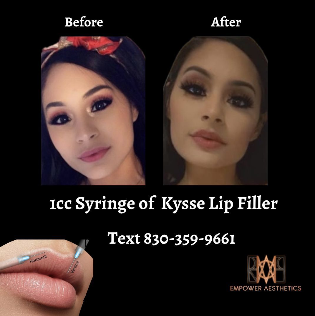 lip-filler-treatment-before-after
