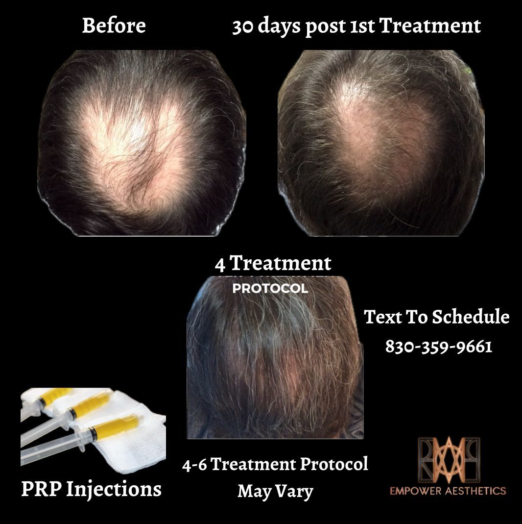 prp-treatment-before-after