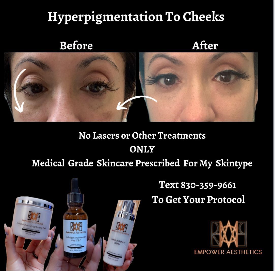 hyperpigmentation-treatment-before-after