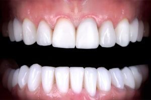 A close up of a person 's teeth on a black background.