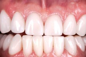 A close up of a person 's teeth with white teeth.