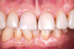 A close up of a person 's teeth with white teeth.
