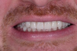 A close up of a man 's mouth with a beard and white teeth.