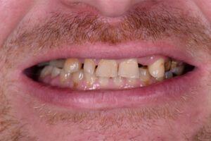 A close up of a man 's mouth with a beard and missing teeth.