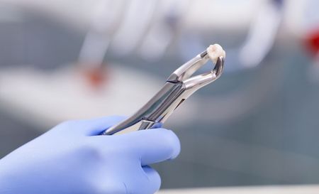 Tooth Extractions

