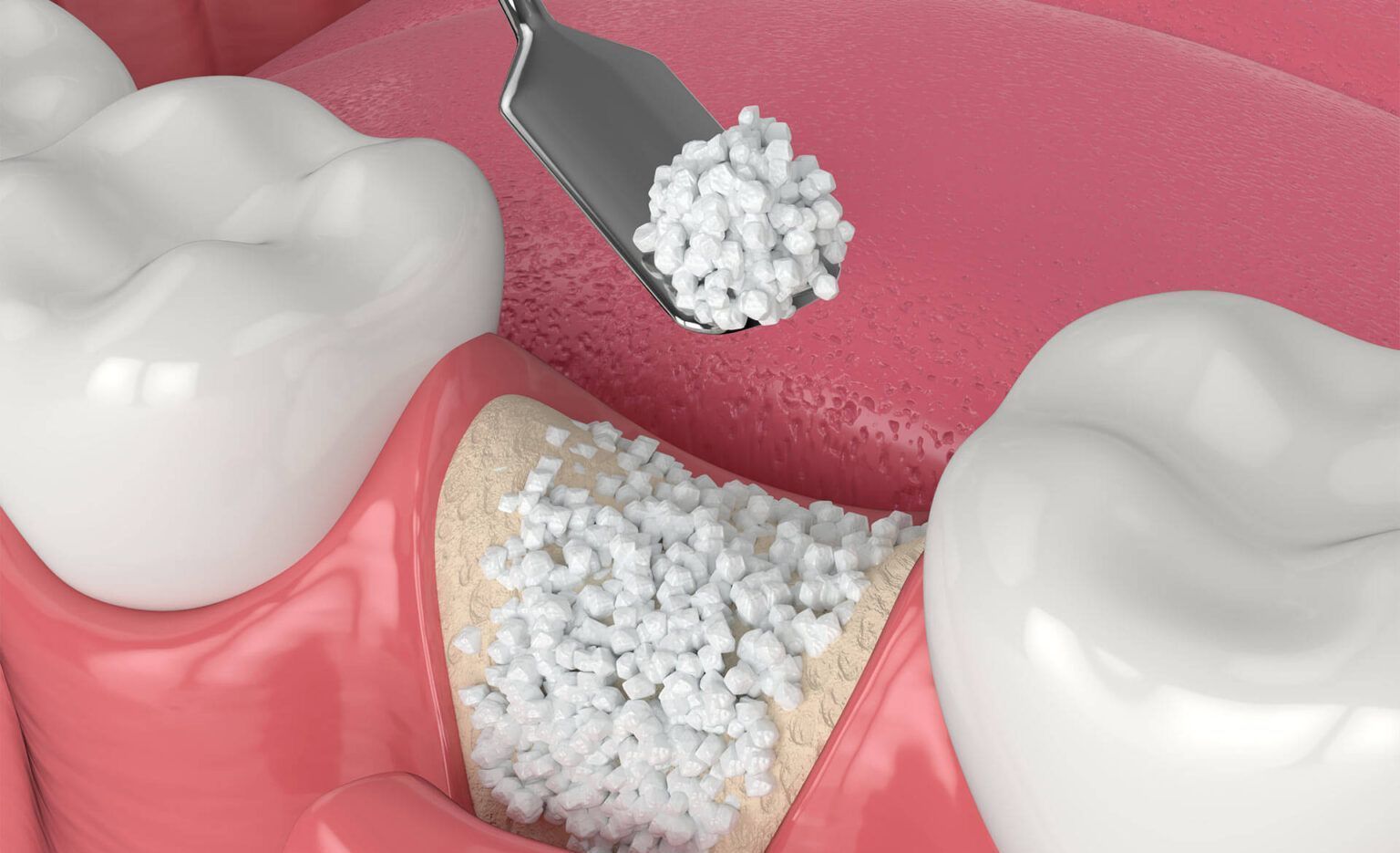 Bone Grafting
