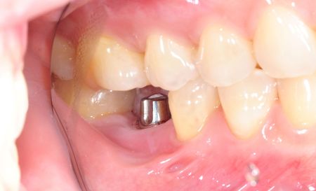Dental Implant Surgery