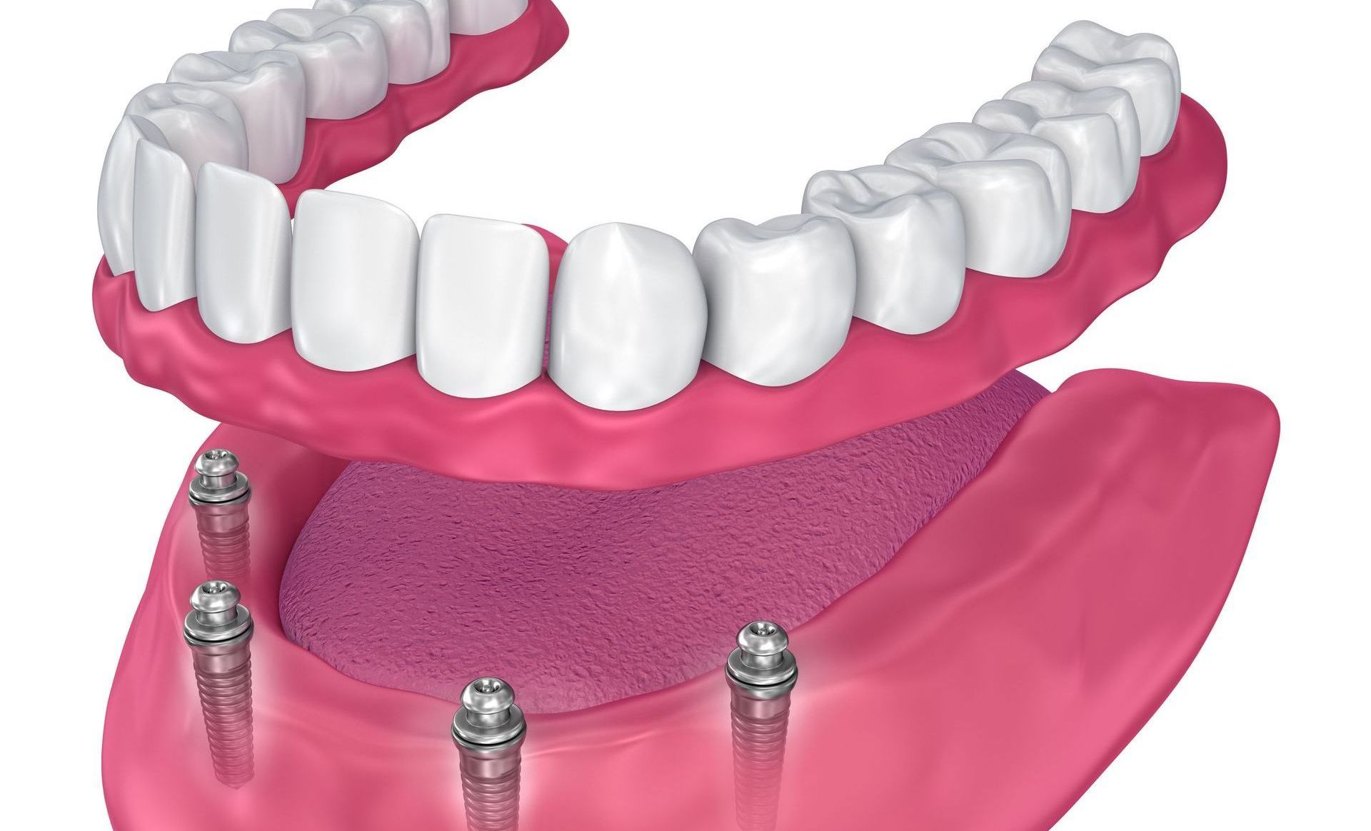 Full Mouth Dental Implants
