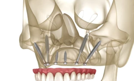 Zygomatic Implants
