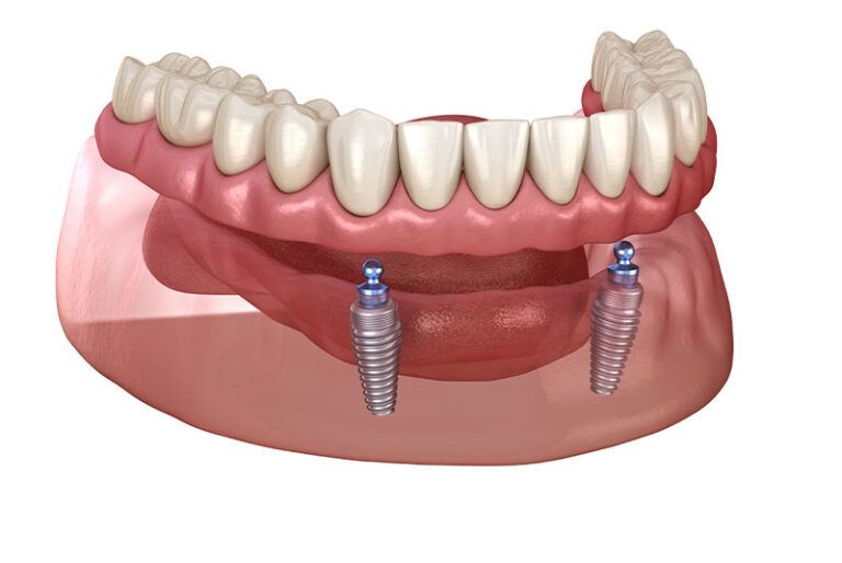 Learn More About Implant-Supported Dentures Implant-Supported Dentures