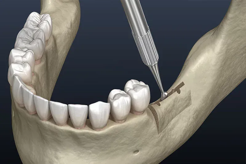 Know More About Ridge Augmentation Ridge Augmentation