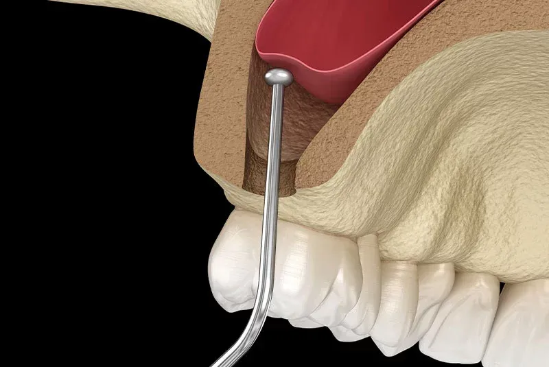 Know More About Sinus Lifts Sinus Lifts
