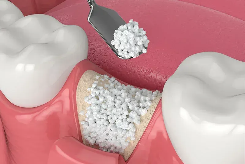 Know more About Socket Preservation Socket Preservation