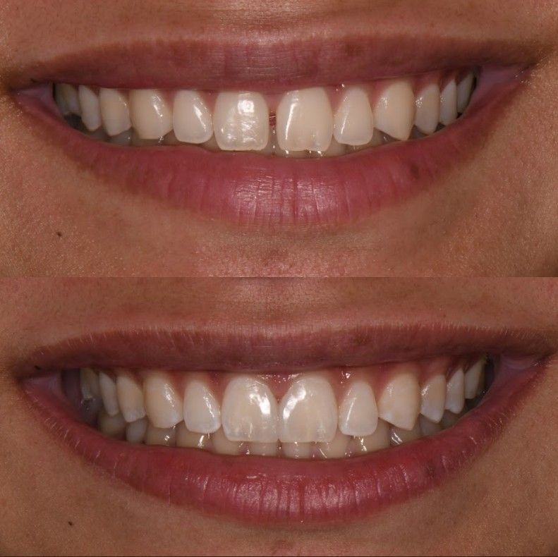 A before and after picture of a woman 's teeth.