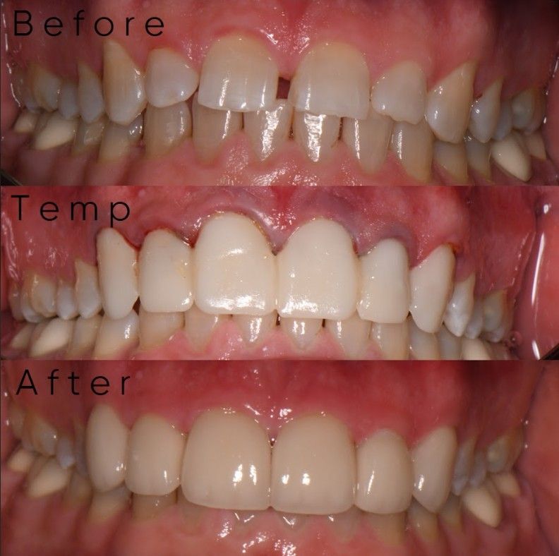 A before and after picture of a person 's teeth