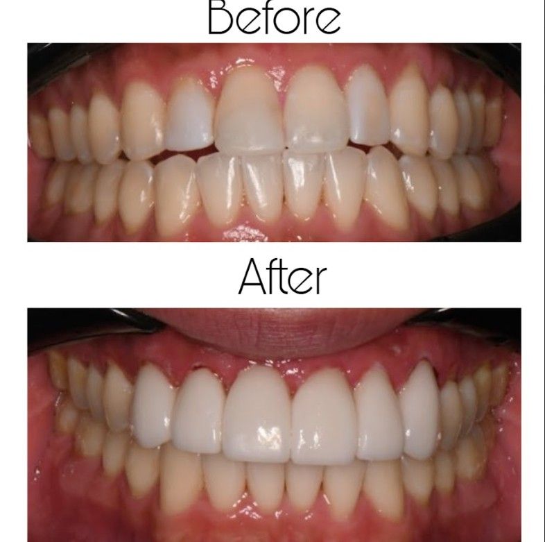 A before and after picture of a person 's teeth