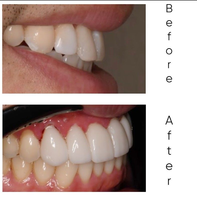 A before and after picture of a person 's teeth