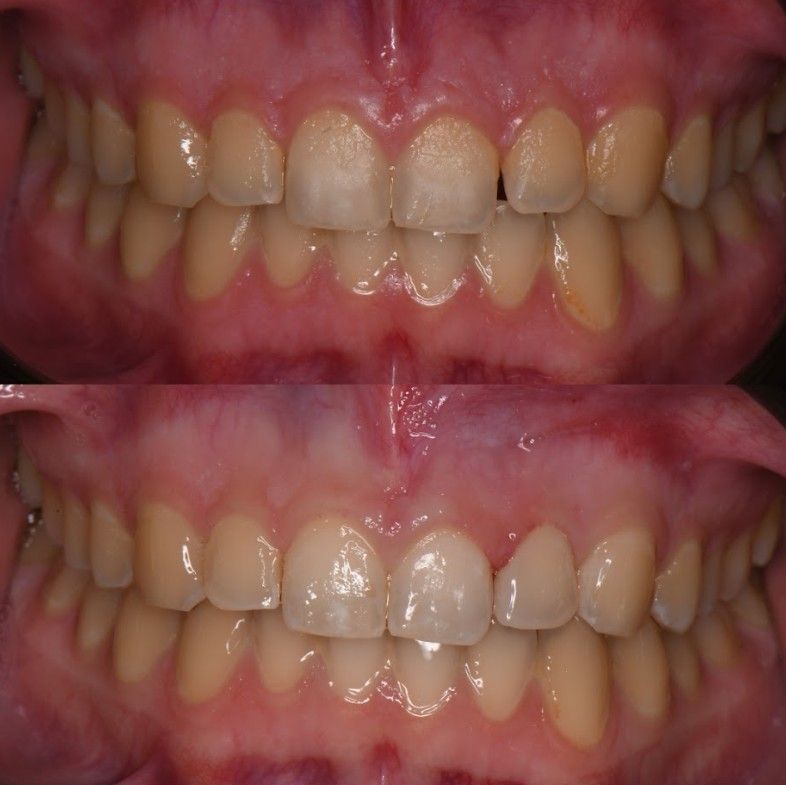A before and after picture of a person 's teeth