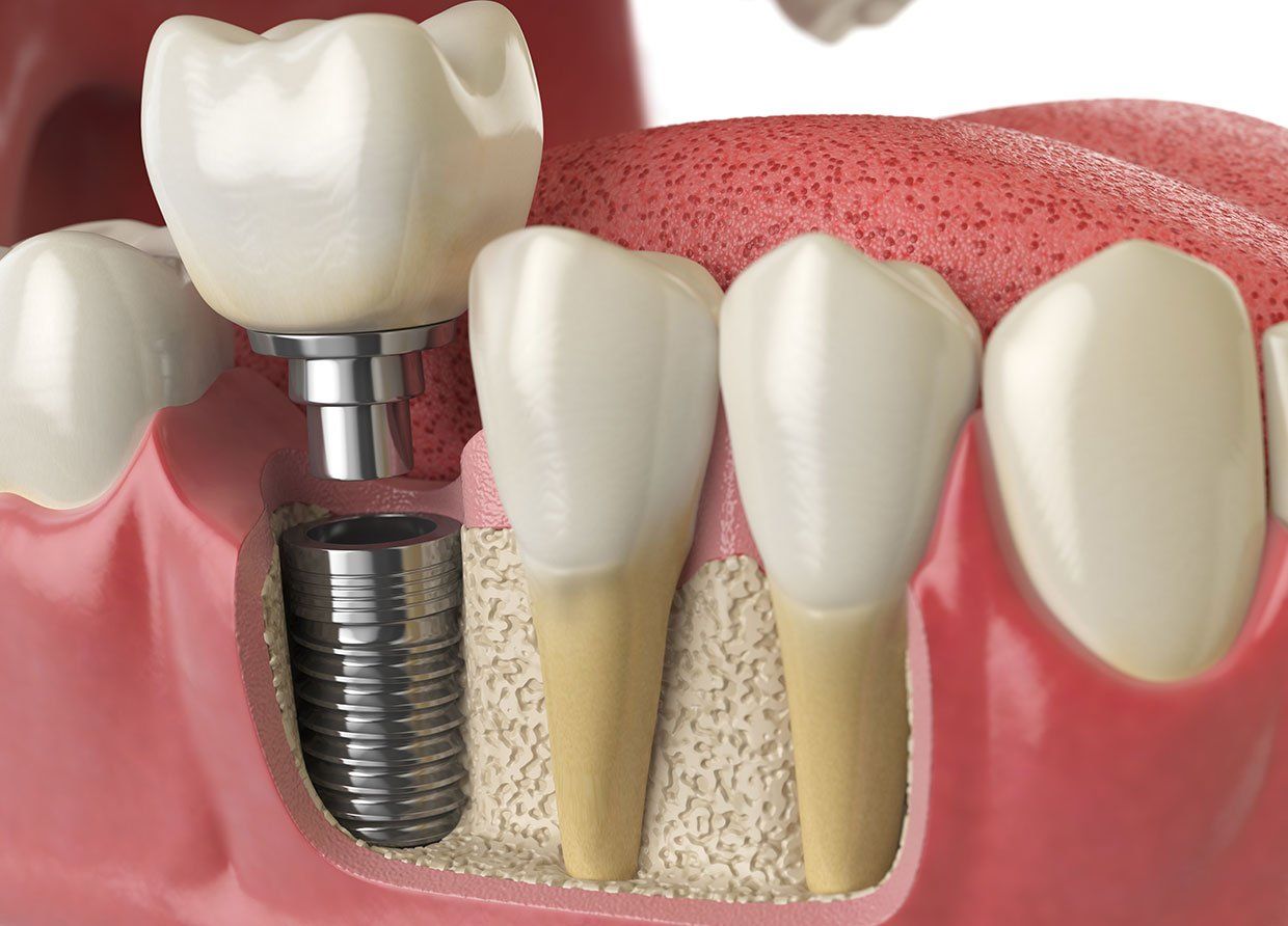 Tooth implant