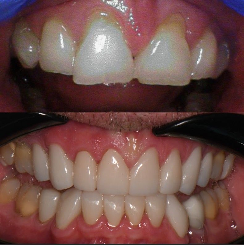 A before and after picture of a person 's teeth