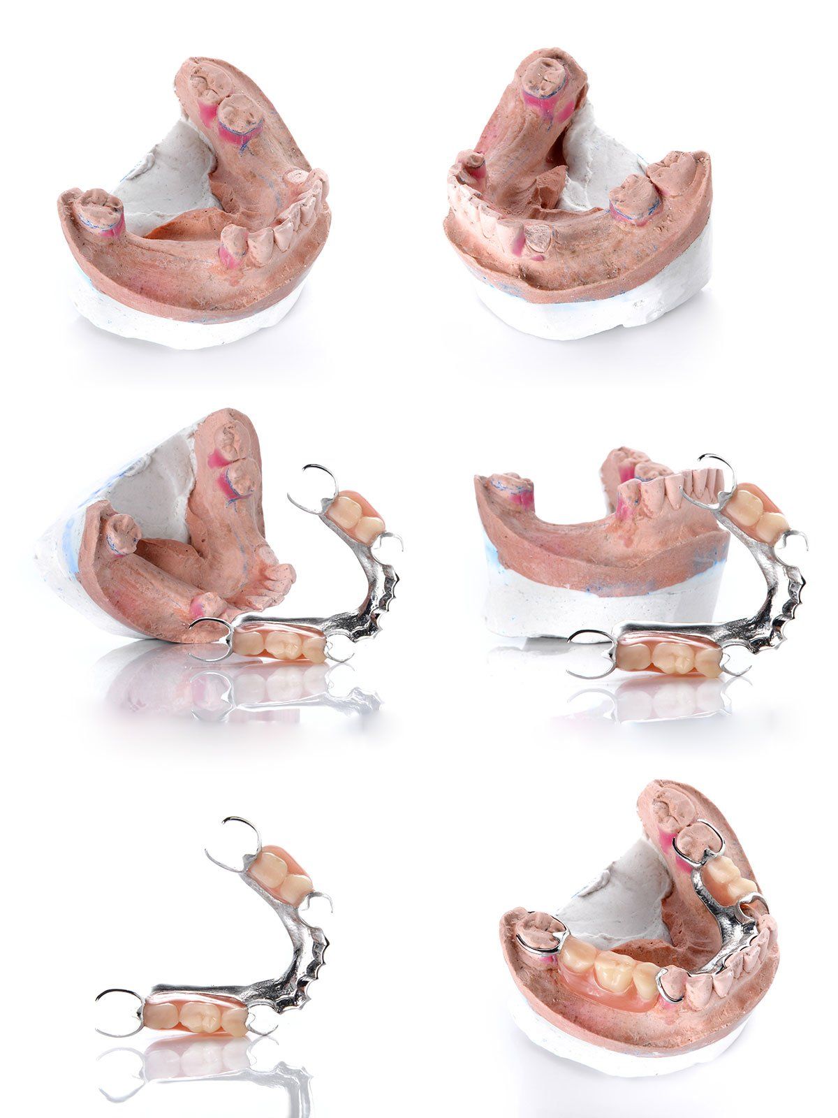 Collection of denture mold