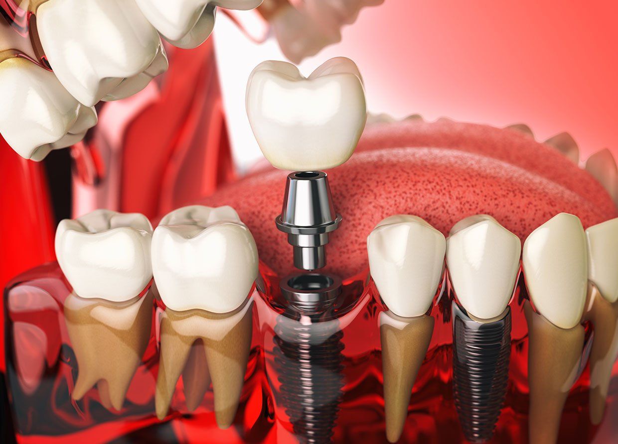 Tooth implant