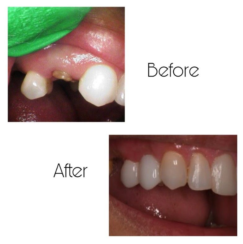 A before and after picture of a person 's teeth