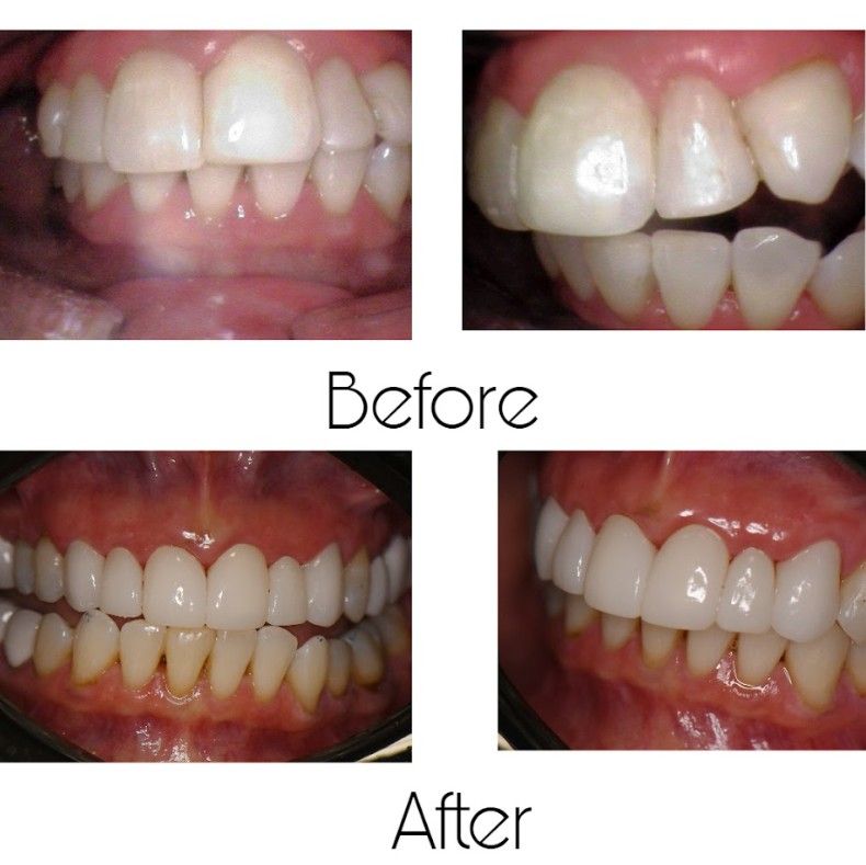 A before and after picture of a person 's teeth