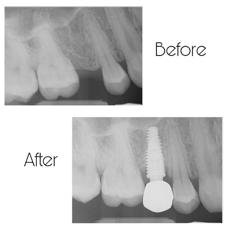 An x-ray of a person 's teeth before and after a dental implant