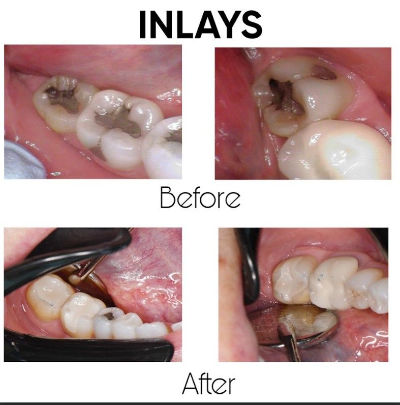 A picture of a person 's teeth before and after inlays