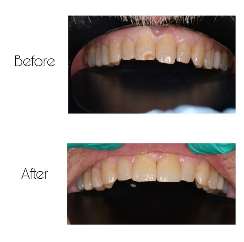 A before and after picture of a person 's teeth