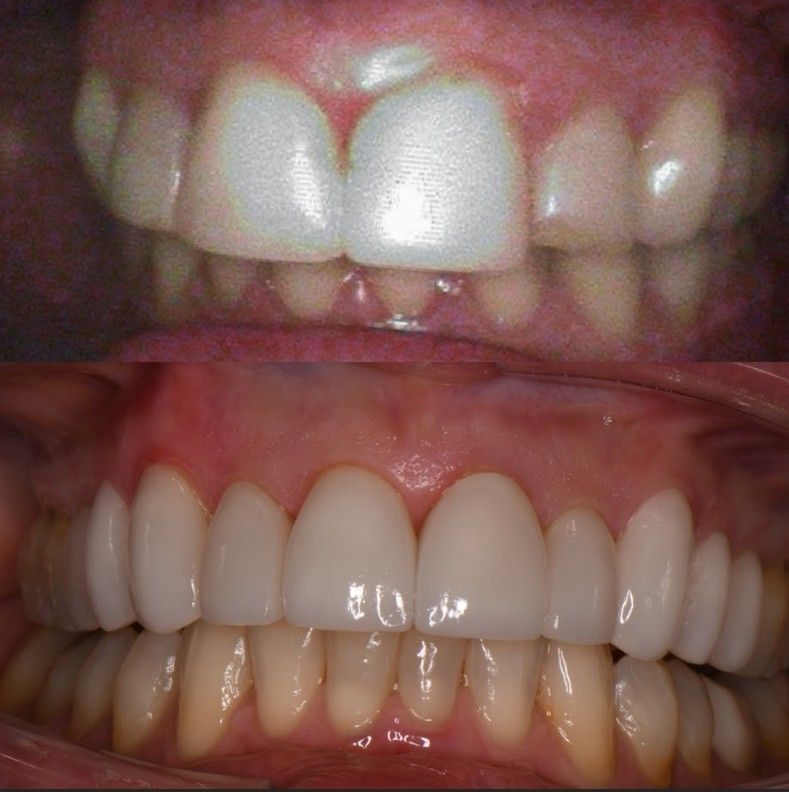 A before and after picture of a person 's teeth