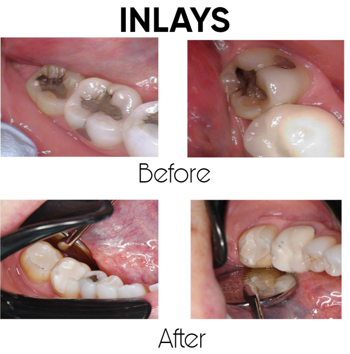 A picture of a person 's teeth before and after inlays