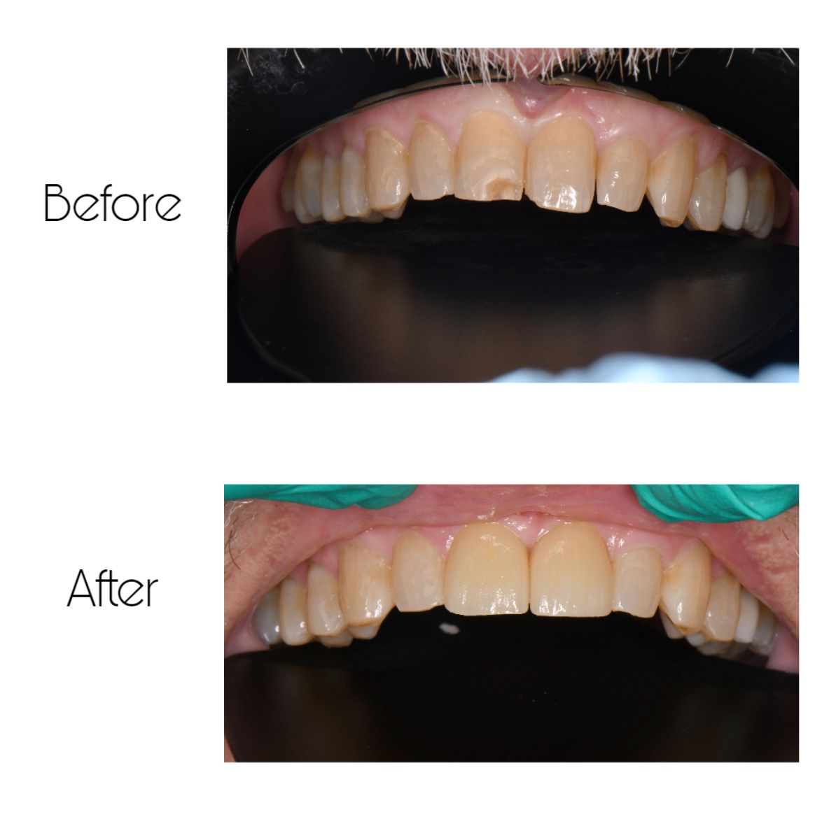 A before and after picture of a person 's teeth