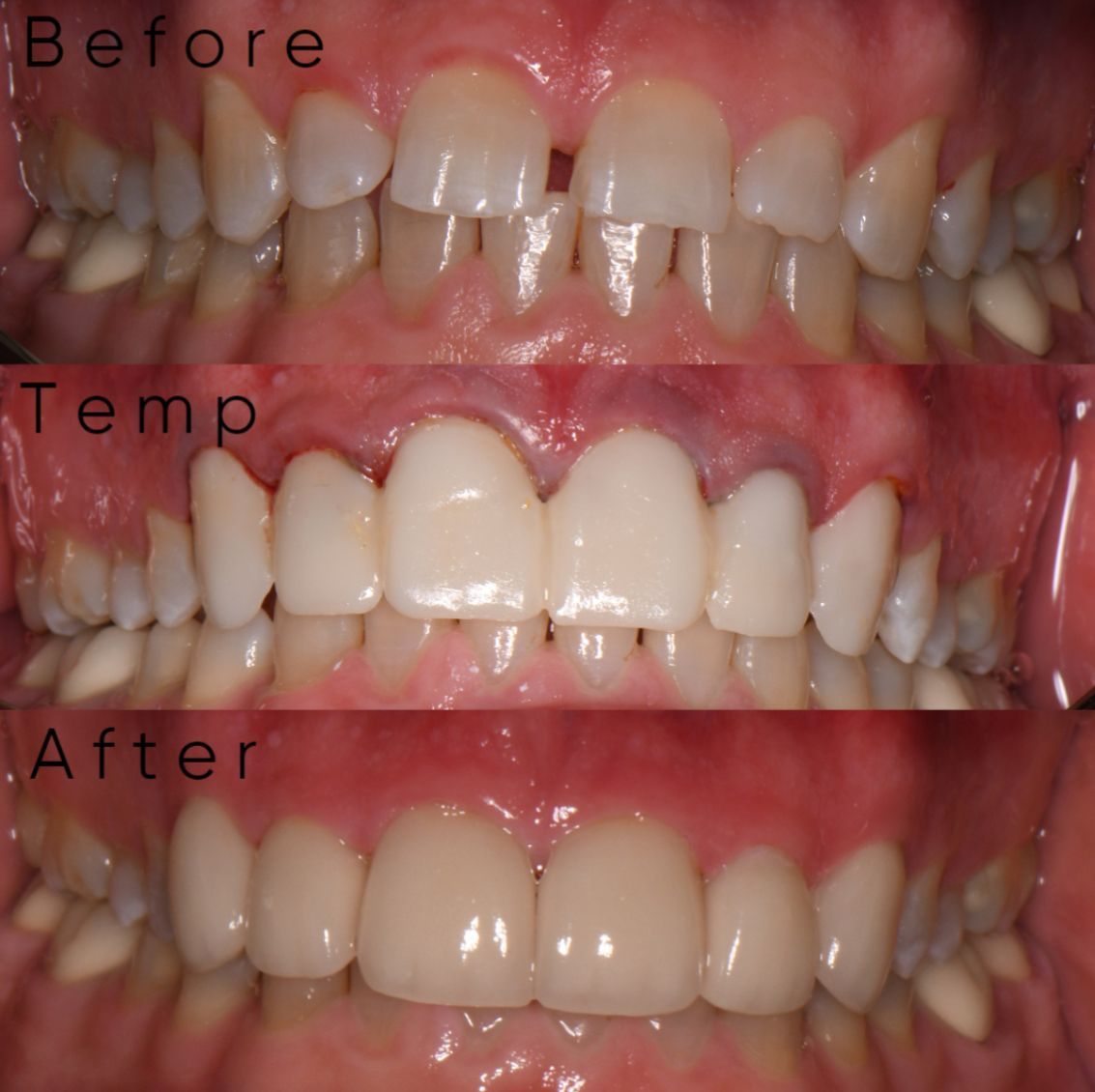 A before and after photo of a person 's teeth