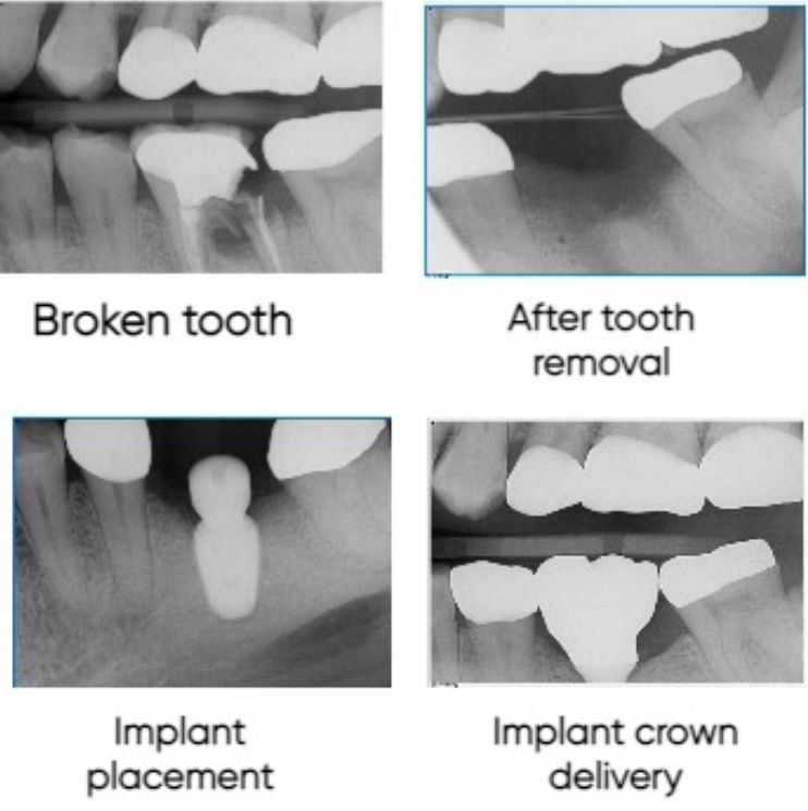 Four x-rays of a broken tooth after tooth removal and implant placement